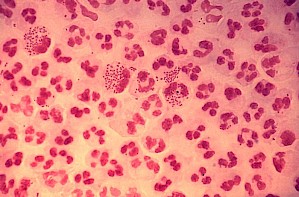 Gram-gefärbte Neisseria gonorrhoeae aus einem Harnröhrenabstrich (PD-USGOV)